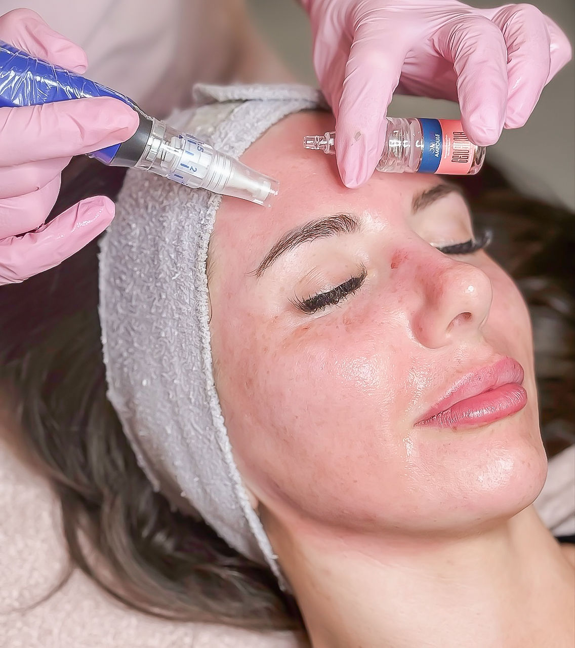 Microneedling